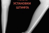 Врачам удалось укрепить кости ребенка с редким заболеванием - «Общественные новости»
