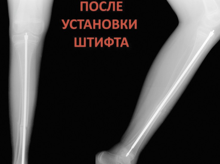 Врачам удалось укрепить кости ребенка с редким заболеванием - «Общественные новости»